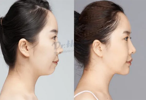 Cằm lẹm tiêm filler có được không? Địa chỉ nào tiêm uy tín