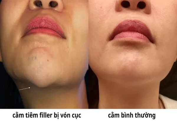 Tiêm filler bị vón cục nhưng không đau là dấu hiệu gì?