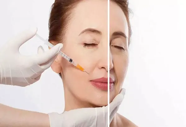 Tiêm filler rãnh cười có nguy hiểm không?